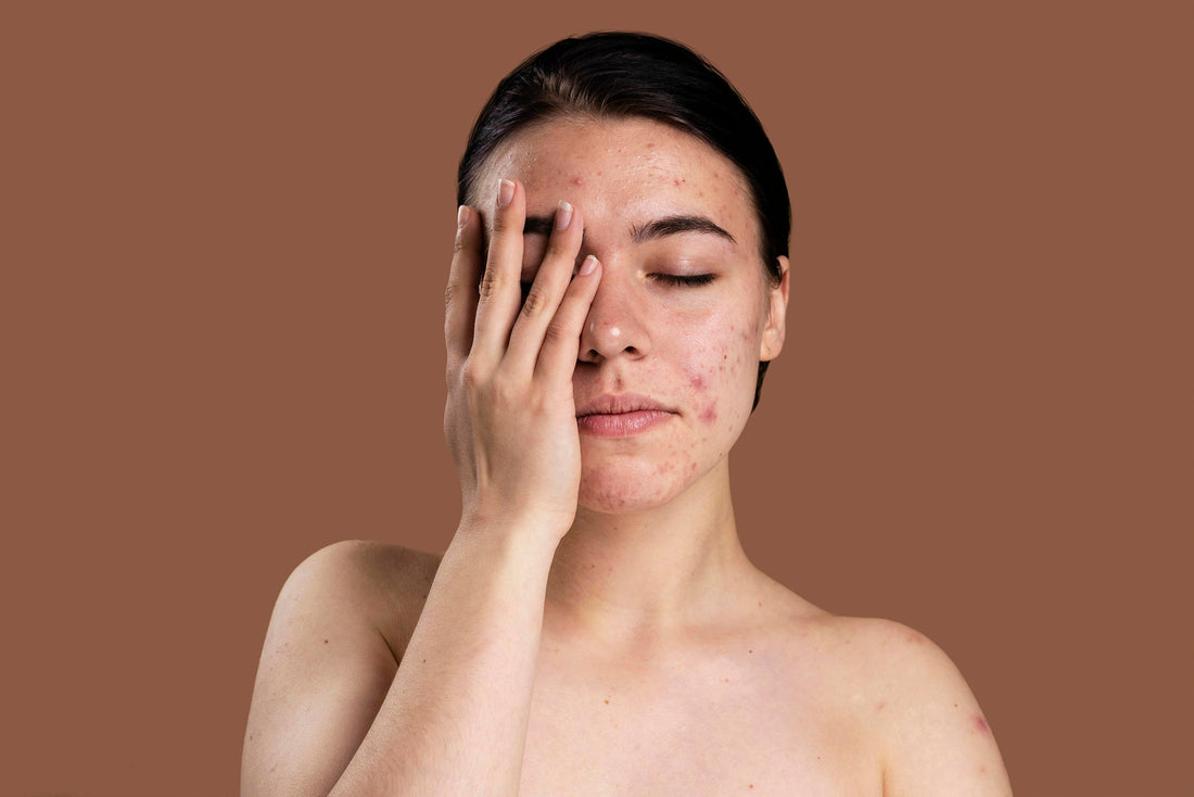 Remedy an Acne Breakout girl with skincare