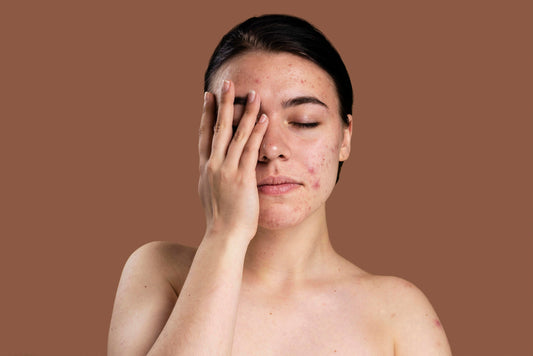 Remedy an Acne Breakout girl with skincare